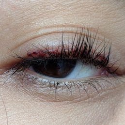 My lash line started burning. She didn't know what to do. My eyes are scabbed from the chemical burn. Called, emailed, texted. no response My lash line started burning. She didn't know what to do. My eyes are scabbed from the chemical burn. Called, emailed, texted. no response
