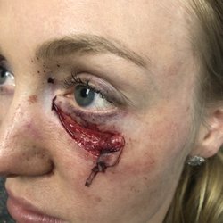 Brian Willoughby, MD - My lower lid was ripped off my a dog
