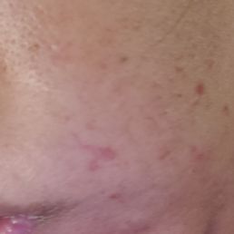Small burn on right cheek