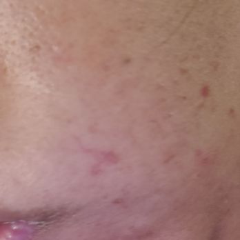 Diya's Threading & Waxing Salon - Small burn on right cheek - Waxing Near Me - Bolingbrook, Illinois