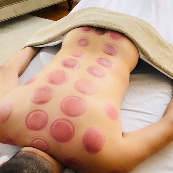 Massage by Yesenia - After cupping massage therapy - Massage Therapy Near Me - Tampa, Florida Massage by Yesenia - After cupping massage therapy - Massage Therapy Near Me - Tampa, Florida