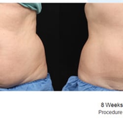 Body Sculpting Spa - CoolSculpting Client