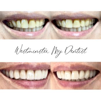 My Dentist - Porcelain Veneers and Porcelain Zirconia Crowns achieved healthy and youthful smile. - General Dentistry Near Me - Westminster, California My Dentist - Porcelain Veneers and Porcelain Zirconia Crowns achieved healthy and youthful smile. - General Dentistry Near Me - Westminster, California