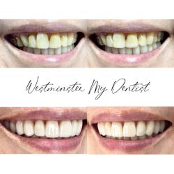 My Dentist - Porcelain Veneers and Porcelain Zirconia Crowns achieved healthy and youthful smile.