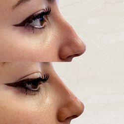 Allure Aesthetics - Nonsurgical Rhinoplasty