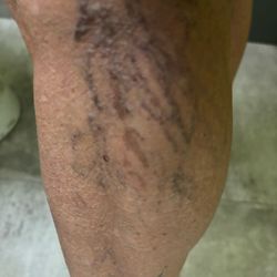 Vein & Vascular Center of South Florida - Worse than before treatment.