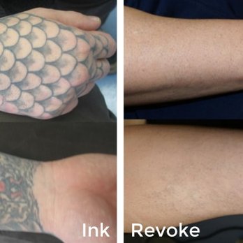 Ink Revoke Tattoo Removal - Tattoo Removal Near Me - Boulder, Colorado