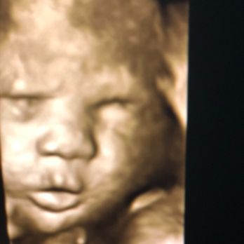 Hello Bambinos - Taken late in the 3rd Trimester on an old Phillips machine. - Diagnostic Imaging Near Me Hello Bambinos - Taken late in the 3rd Trimester on an old Phillips machine. - Diagnostic Imaging Near Me