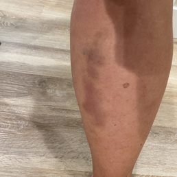 Bruising on calves the day following the pedicure.
