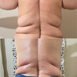 Pure Beauty Esthetics - Body sculpting on back