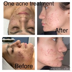 Michael Adam Skin - Only after one acne treatment! Acne treatment is a process but well with the wait with an experienced clinician!