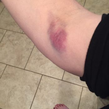 Labcorp - Got labs drawn yesterday. Within an hr or two this is what my arm looked like. Frustrated and sore! - Laboratory Testing Near Me - San Antonio, Texas Labcorp - Got labs drawn yesterday. Within an hr or two this is what my arm looked like. Frustrated and sore! - Laboratory Testing Near Me - San Antonio, Texas