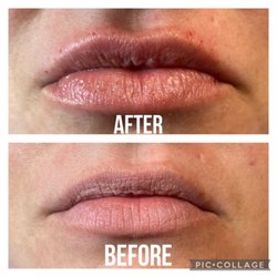 LYFT Facial Rejuvination - Lip filler Hyaluron pen