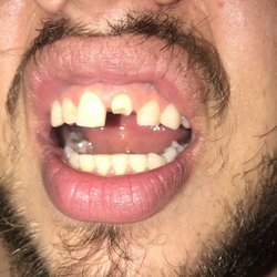 Andrew R. Strickland DMD - Plainville Family Dental - Before