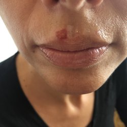 Lady-derma-studio - The burn from wax too hot, 2 days later!