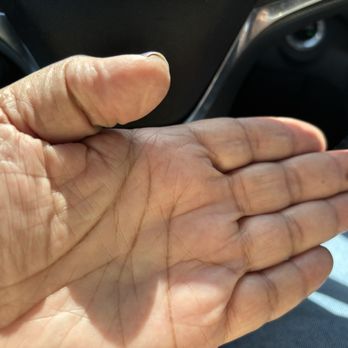 Dedicated Senior Medical Center - Parasite embedded in my hand causing engorgement, itching and burning. - Acupuncture Near Me - Winter Park, Florida Dedicated Senior Medical Center - Parasite embedded in my hand causing engorgement, itching and burning. - Acupuncture Near Me - Winter Park, Florida