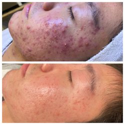 Acne Solutions Skin Care & Spa