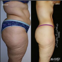 Eden Beauty Bar - Ice Therapy Body Contouring