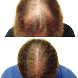 Hair Transplant Hawaii