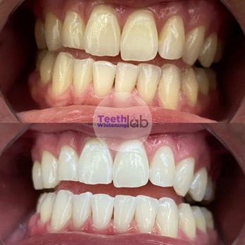 Teeth Whitening Lab - Teeth Whitening Near Me - Long Beach, California Teeth Whitening Lab - Teeth Whitening Near Me - Long Beach, California