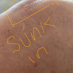 Desert Orthopaedic Center - Sunken scar