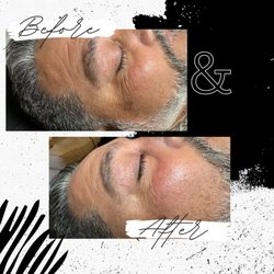Deosoli Beauty - Microchanneling Before and After