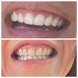 Sanchez E Carlos, DDS - Bottom before, top after