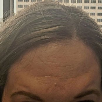 Bella Sol Med Spa - Bulges over each eyebrow as a result of Botox. It looked worse in person. - Medical Spas Near Me - Chino, California