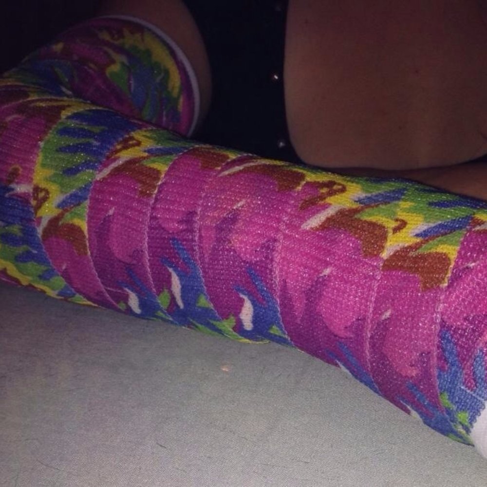 Seattle Orthopedic Center - Cast that was wrapped so tight it had to be taken off because I had lost feeling in my hand. - Orthopedists Near Me - Seattle, Washington Seattle Orthopedic Center - Cast that was wrapped so tight it had to be taken off because I had lost feeling in my hand. - Orthopedists Near Me - Seattle, Washington