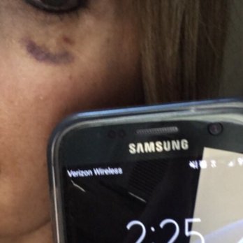 Moradi, MD - My black eye...still there - Body Contouring Near Me - Vista, California