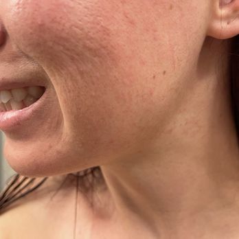 Avalon Laser - My skin after Avalon - Laser Hair Removal Near Me - San Diego, California Avalon Laser - My skin after Avalon - Laser Hair Removal Near Me - San Diego, California