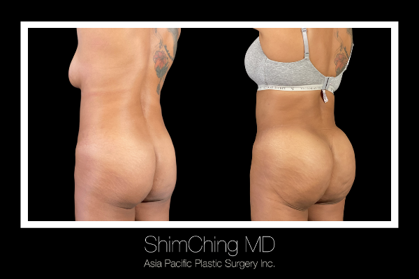 Brazilian Butt Lift - The Brazilian butt lift or BBL is a body sculpting procedure in which fat is taken from various areas of the body and transplanted to the hips and buttocks.