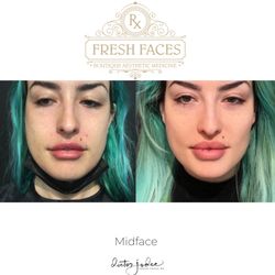 Fresh Faces Rx - Midface filler