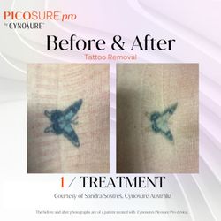 Beauty Drip Medspa - Tattoo removal on your mind?