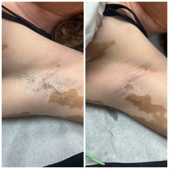 Snatched Skn - Underarm wax - Estheticians Near Me - Elmwood Park, Illinois Snatched Skn - Underarm wax - Estheticians Near Me - Elmwood Park, Illinois