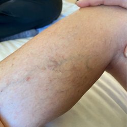 USA Vein Clinics - Before photo of my worst area.