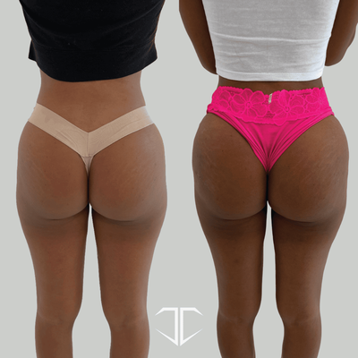 Instant BBL - Are you looking for a little boost in your butt? Want to add volume and shape to your backside without committing to surgery? It can be done with dermal filler injections, otherwise known as an Instant BBL.
The Instant BBL remains a popular procedure because of the subtle ‘pop’ it gives to the backside to improve the contour and shape while providing a more lifted look.
SCHEDULE A CONSULTATION TODAY! Instant BBL - Are you looking for a little boost in your butt? Want to add volume and shape to your backside without committing to surgery? It can be done with dermal filler injections, otherwise known as an Instant BBL.
The Instant BBL remains a popular procedure because of the subtle ‘pop’ it gives to the backside to improve the contour and shape while providing a more lifted look.
SCHEDULE A CONSULTATION TODAY!