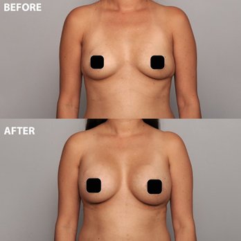 David Cho, MD - Breast Augmentation - Dr. David Cho - Cosmetic Surgeons Near Me - Honolulu, Hawaii David Cho, MD - Breast Augmentation - Dr. David Cho - Cosmetic Surgeons Near Me - Honolulu, Hawaii