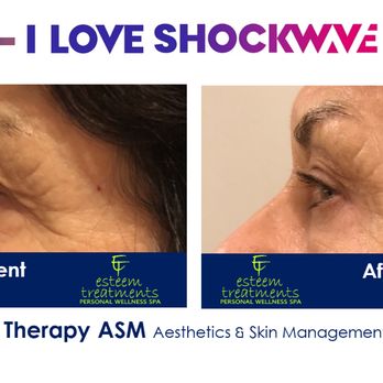 Esteem Treatments - This is a before and immediately after this clients very first flashwave facial. - Medical Spas Near Me - Victoria, British Columbia Esteem Treatments - This is a before and immediately after this clients very first flashwave facial. - Medical Spas Near Me - Victoria, British Columbia