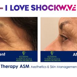 Esteem Treatments - This is a before and immediately after this clients very first flashwave facial.