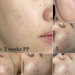 Halo Aesthetics by Missy - : After 6 treatments of microdermabrasion and using the right products the pigmentation from acne scarring was lifted and lighten.
