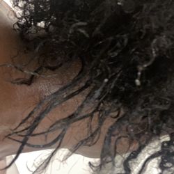 Extreme Heat/Chemical damage to one side of the back of my head