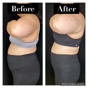 Oc Sculpt Studio - Results after 2 sessions of Ultrasonic Cavitation - Body Contouring Near Me Oc Sculpt Studio - Results after 2 sessions of Ultrasonic Cavitation - Body Contouring Near Me