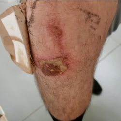 Banner Casa Grande Urgent Care - This is the infected wound on a pediatric patient that was turned away by management at nextcare, yeah I know what in the heck right.