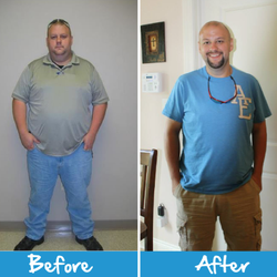 Roller Weight Loss and Advanced Surgery