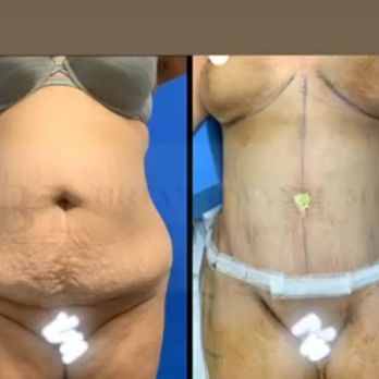 Brian Hwang ,MD - Tummy Tuck & BBl - Plastic Surgeons Near Me - Los Angeles, California Brian Hwang ,MD - Tummy Tuck & BBl - Plastic Surgeons Near Me - Los Angeles, California