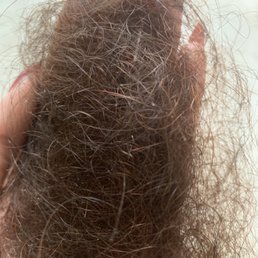 Daily hair loss for 2 months from chemical burning