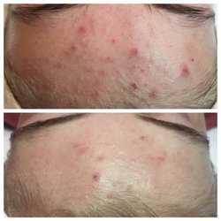 Wendy Sula Skin + Brows - 4 weeks, 1 treatment plus homecare