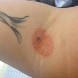 Labcorp - My right arm after visiting Labcorp