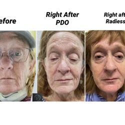 Vital Aesthetics - Full face non-surgical face lift with PDO threads and filler